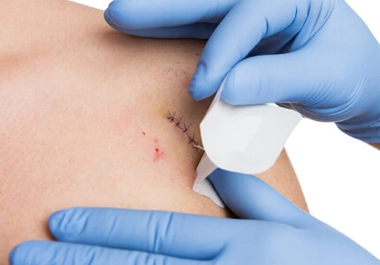 Minor Surgical Incisions