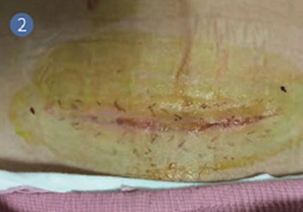 Postoperative Wound