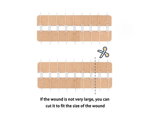 wound closure device